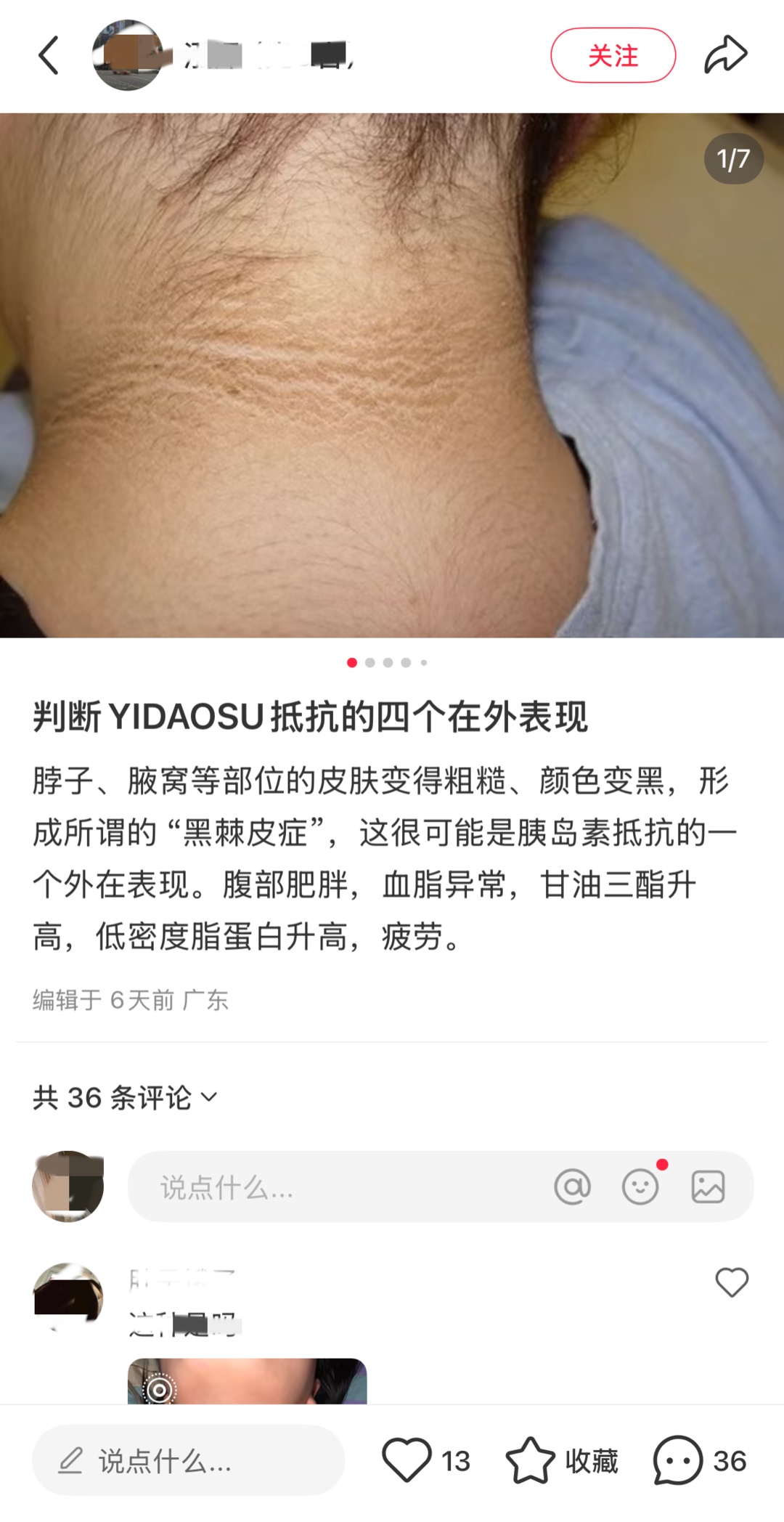 网友晒照求诊:“黑脖子”是胰岛素抵抗?专家:不可靠! 网友晒照求诊:“黑脖子”是胰岛素抵抗?专家:不可靠!