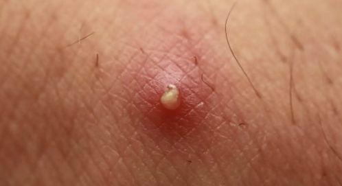 警惕!身上长了这种“小凸起”, 千万别随便抠! 警惕!身上长了这种“小凸起”, 千万别随便抠!