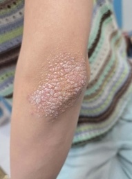 女生患上怪病!一到傍晚就全身痒…… 女生患上怪病!一到傍晚就全身痒……