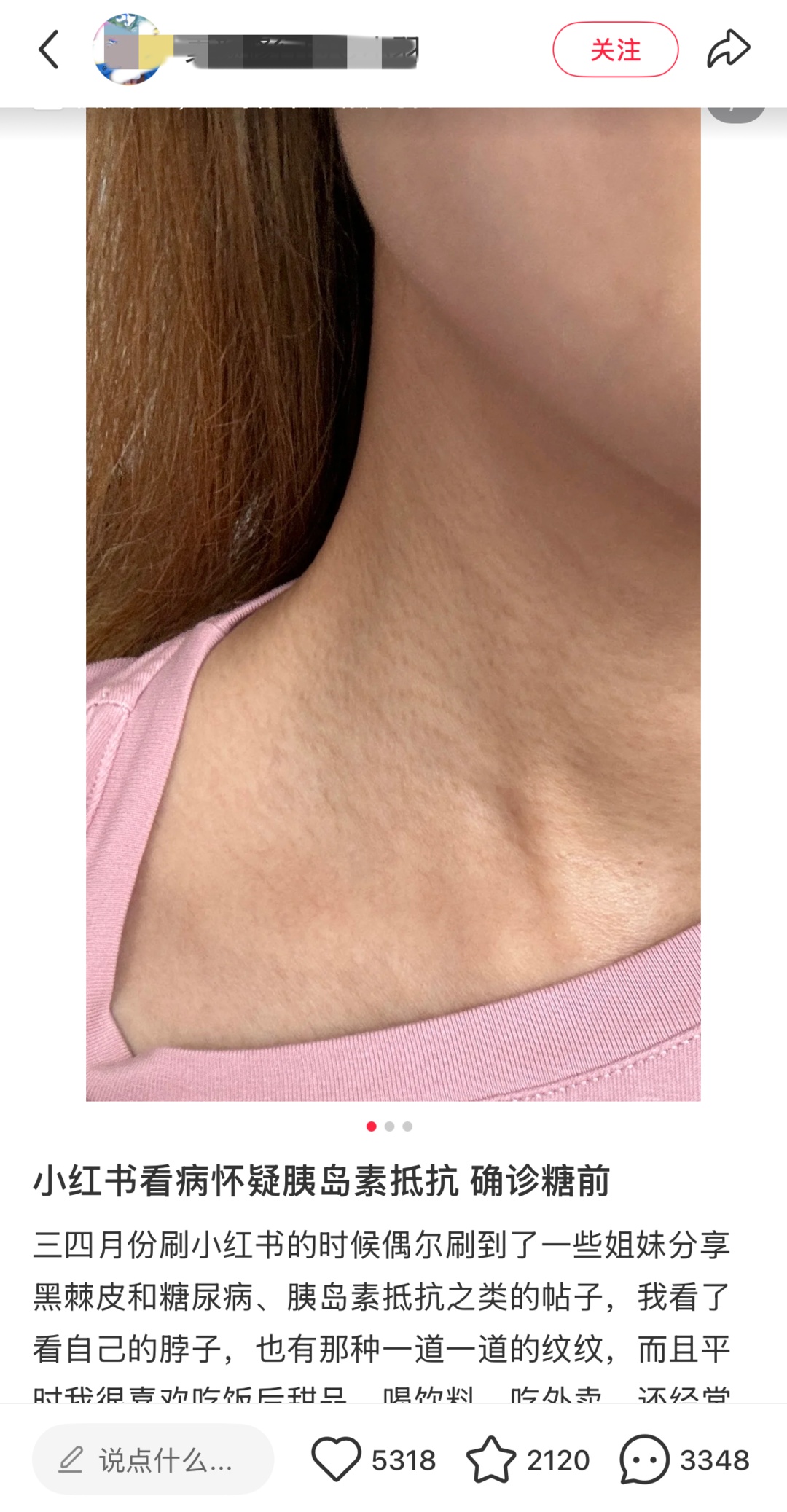 网友晒照求诊:“黑脖子”是胰岛素抵抗?专家:不可靠! 网友晒照求诊:“黑脖子”是胰岛素抵抗?专家:不可靠!