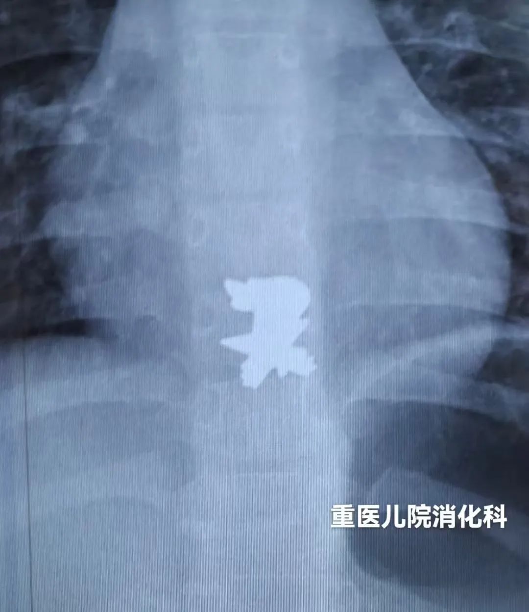 近期频发!一个月接诊近20例误食“少先队队徽或其磁铁”儿童 近期频发!一个月接诊近20例误食“少先队队徽或其磁铁”儿童