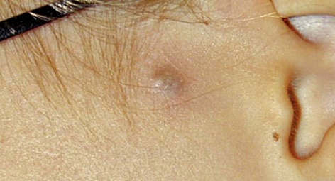 警惕!身上长了这种“小凸起”, 千万别随便抠! 警惕!身上长了这种“小凸起”, 千万别随便抠!