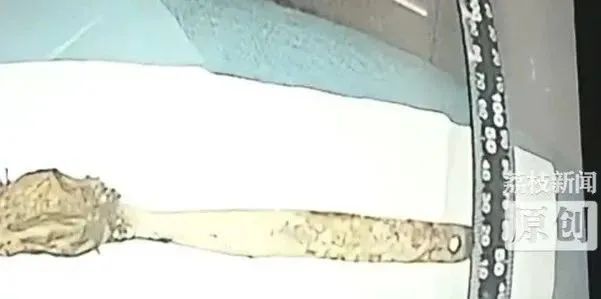 以为做梦,男子竟将15cm长咖啡勺“遗忘”腹中半年! 以为做梦,男子竟将15cm长咖啡勺“遗忘”腹中半年!