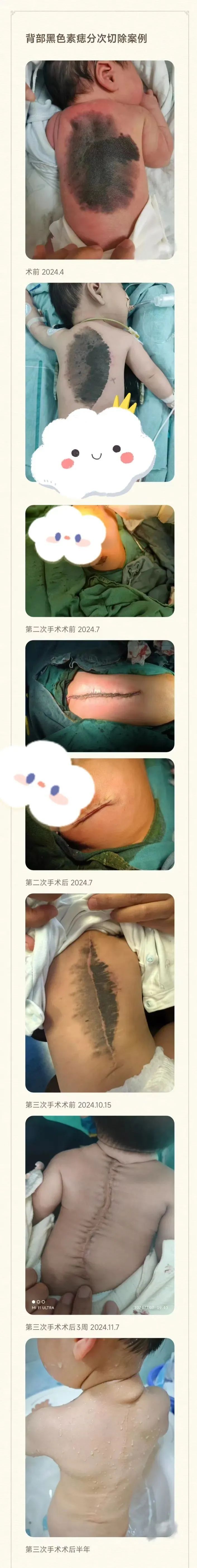 “换背”成功！婴儿出生后竟发现一大片黑痣！被确诊为…