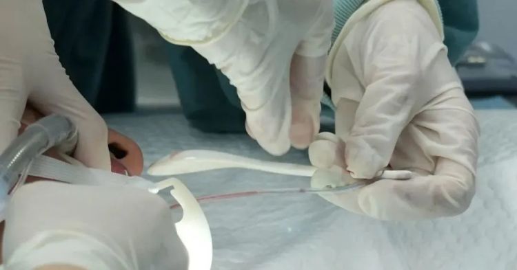 男子旅行时离奇“失忆”，半年后发现腹中躺着一支近15厘米咖啡勺……