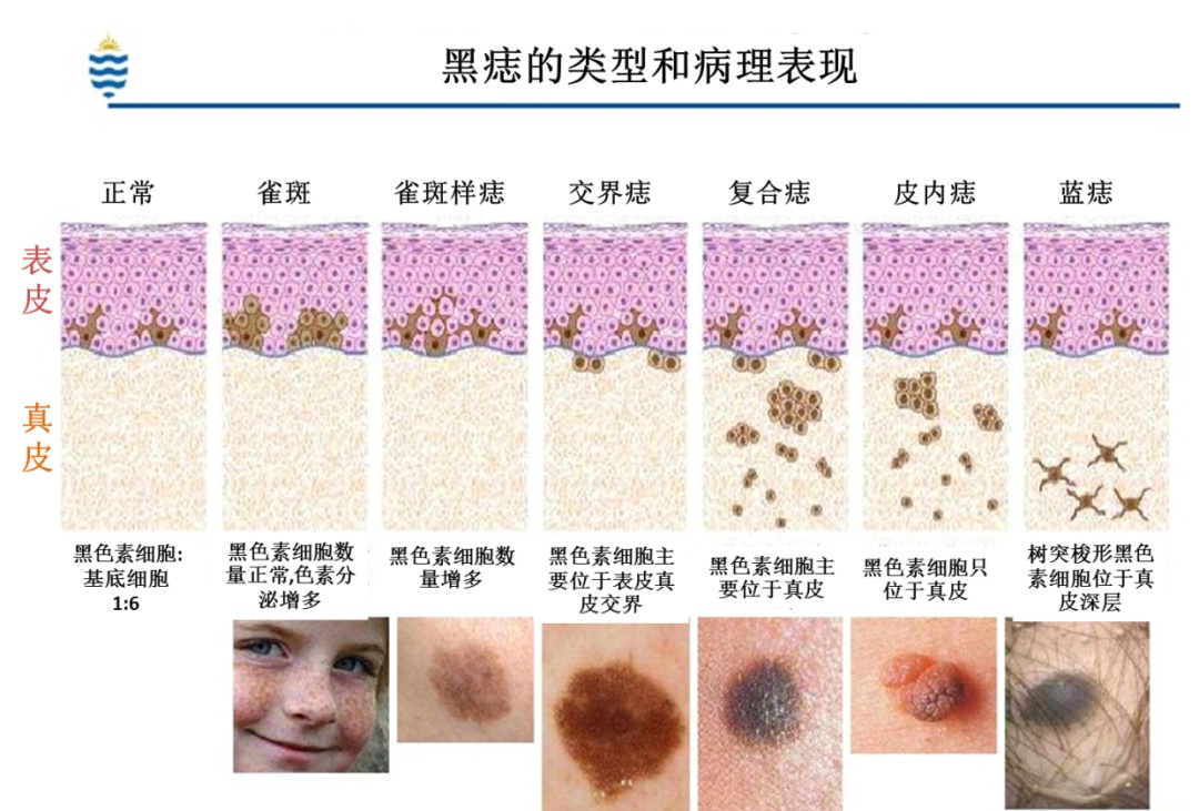 “换背”成功！婴儿出生后竟发现一大片黑痣！被确诊为…