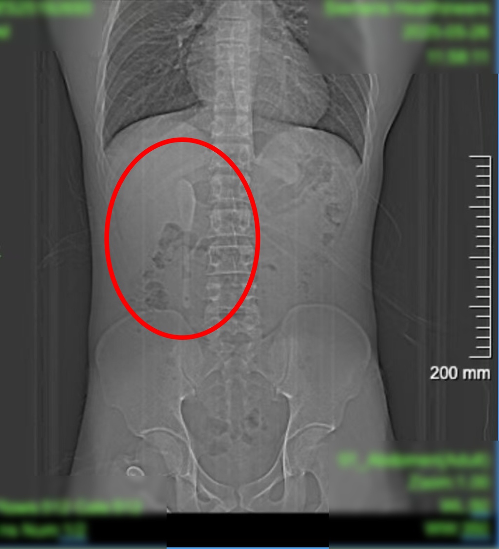 惊呆了!男子泰国旅行离奇“失忆”,半年后肚子里竟发现…… 惊呆了!男子泰国旅行离奇“失忆”,半年后肚子里竟发现……
