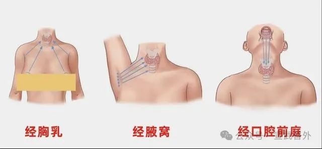 悄悄扰乱钙平衡的隐形杀手:带你认识甲状旁腺瘤 悄悄扰乱钙平衡的隐形杀手:带你认识甲状旁腺瘤