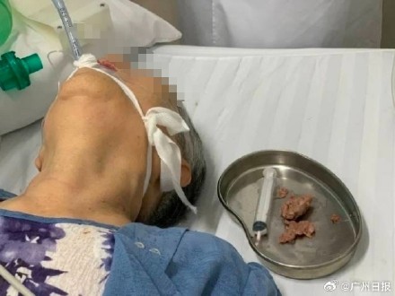 食不言需谨记!广州女子吃饭时聊天 牛肉球呛入气管 食不言需谨记!广州女子吃饭时聊天 牛肉球呛入气管