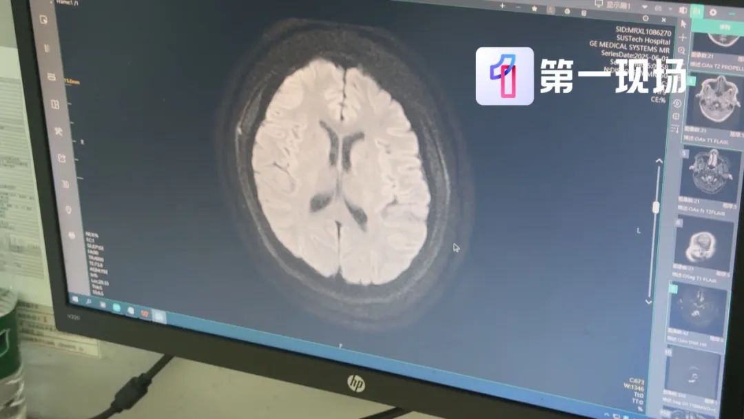 20岁小伙抽搐昏迷!频繁感冒竟让免疫系统“叛变” 20岁小伙抽搐昏迷!频繁感冒竟让免疫系统“叛变”