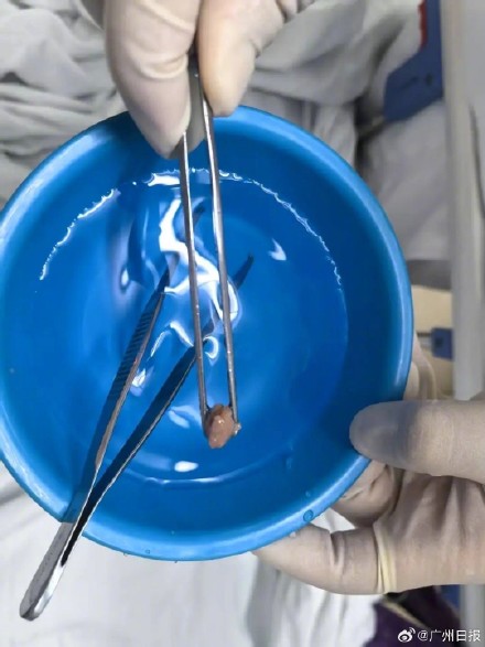 食不言需谨记!广州女子吃饭时聊天 牛肉球呛入气管 食不言需谨记!广州女子吃饭时聊天 牛肉球呛入气管