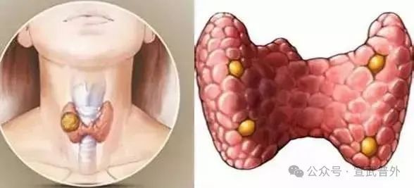 悄悄扰乱钙平衡的隐形杀手:带你认识甲状旁腺瘤 悄悄扰乱钙平衡的隐形杀手:带你认识甲状旁腺瘤