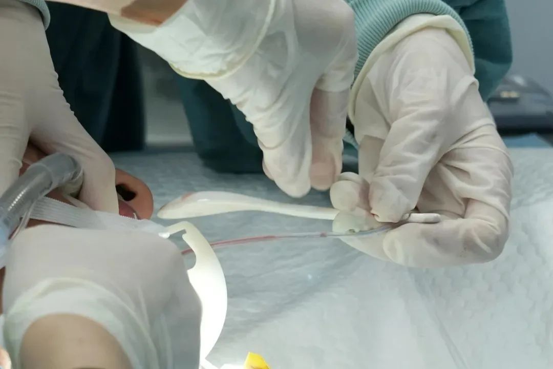 15cm咖啡勺被遗忘腹中半年!男子对此毫无记忆,直到…… 15cm咖啡勺被遗忘腹中半年!男子对此毫无记忆,直到……