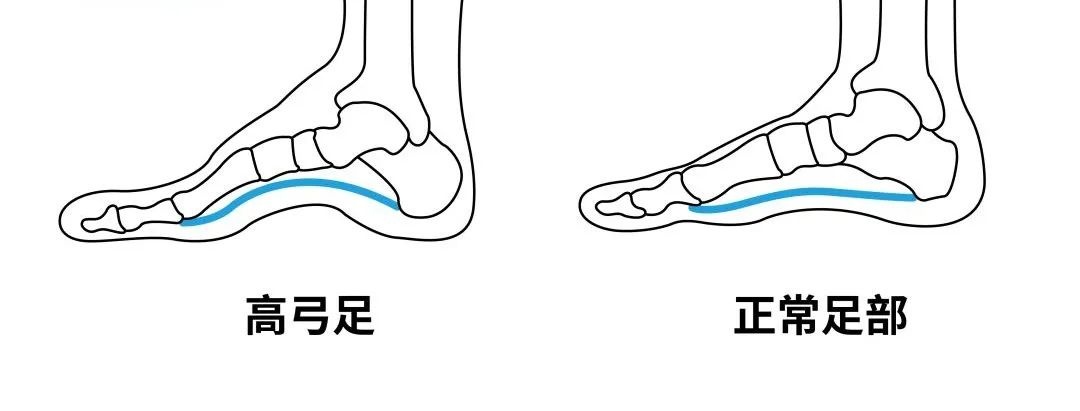 走路跑步总累？可能是脚的这个地方出了问题