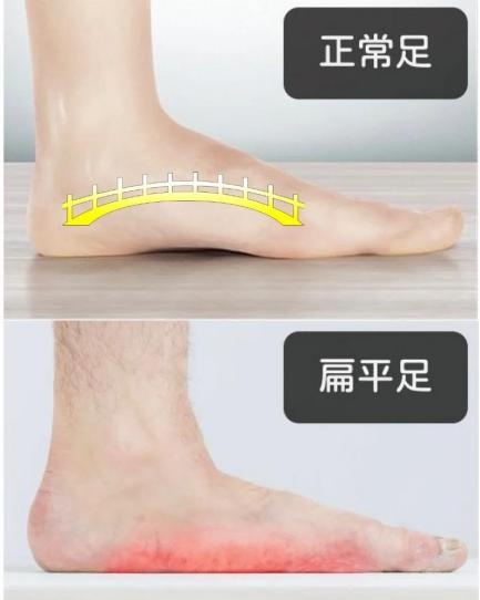 走路跑步总累？可能是脚的这个地方出了问题