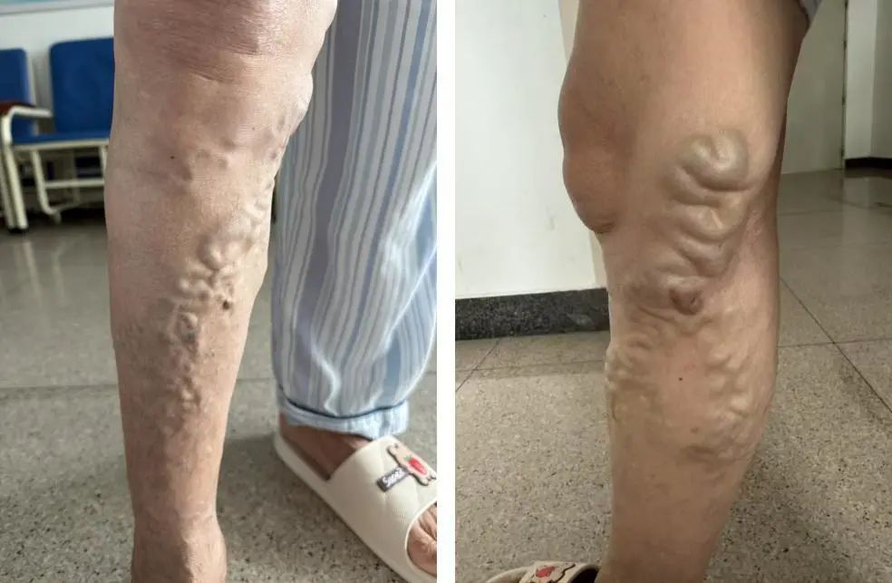 59岁女子小腿“长满蚯蚓”20年不敢穿裙子,医生:久站久坐最易中招 59岁女子小腿“长满蚯蚓”20年不敢穿裙子,医生:久站久坐最易中招