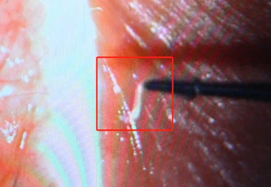 不要拍!有人已中招,眼内取出4条蠕动的寄生虫 不要拍!有人已中招,眼内取出4条蠕动的寄生虫