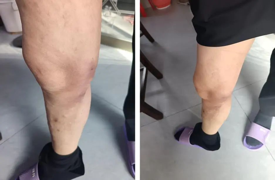 59岁女子小腿“长满蚯蚓”20年不敢穿裙子,医生:久站久坐最易中招 59岁女子小腿“长满蚯蚓”20年不敢穿裙子,医生:久站久坐最易中招