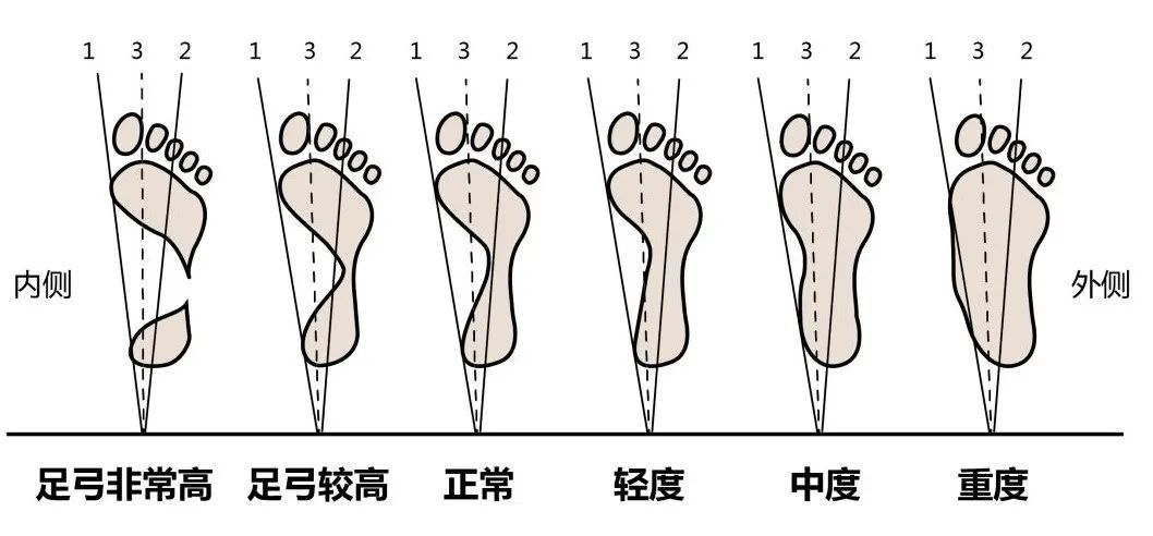 走路跑步总累？可能是脚的这个地方出了问题