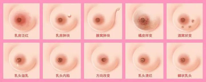 夫妻双双确诊乳腺癌!医生:罪魁祸首很常见,赶紧自查→ 夫妻双双确诊乳腺癌!医生:罪魁祸首很常见,赶紧自查→