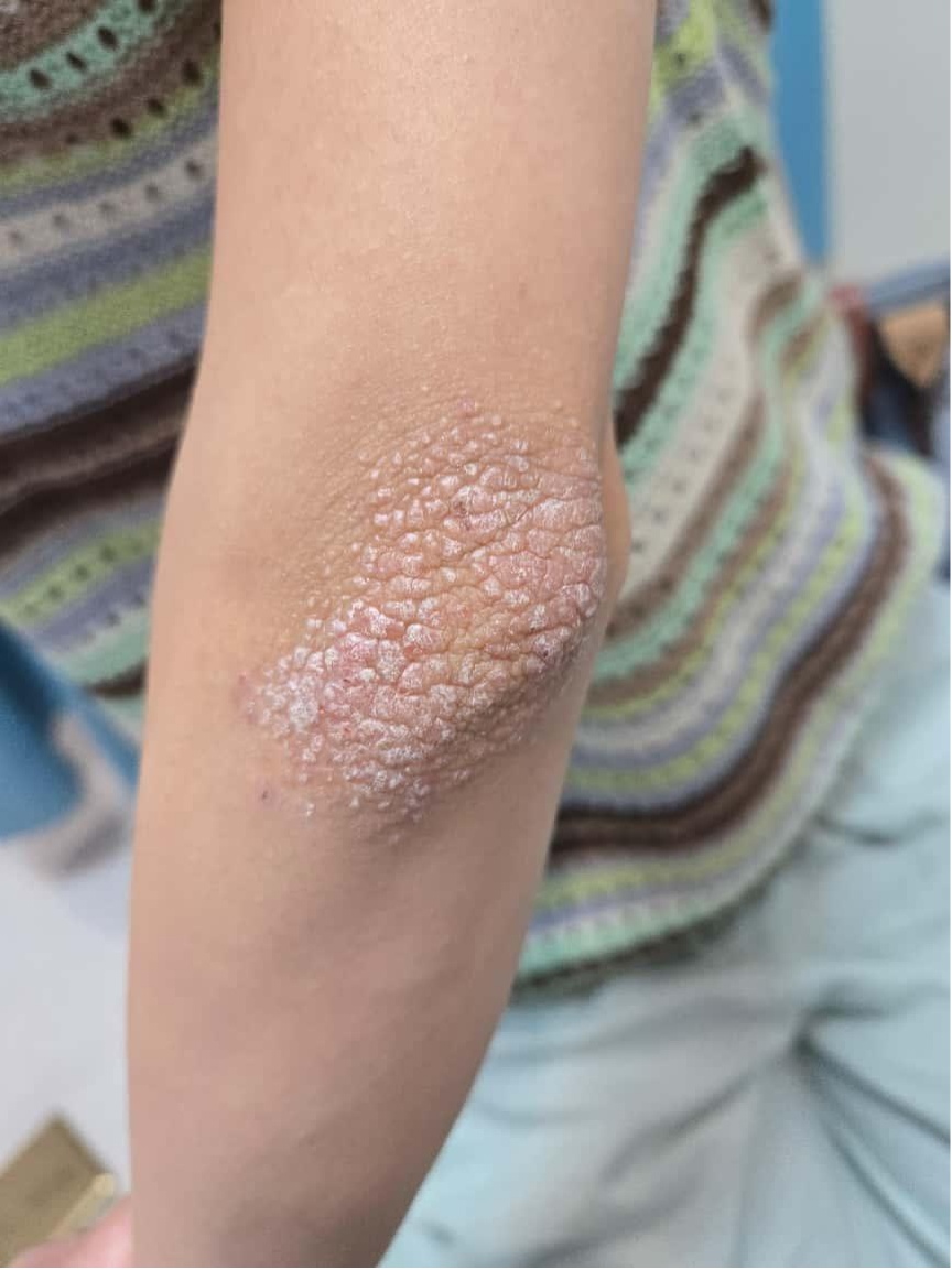 浙江一初三女生患上怪病,一到傍晚就全身痒!竟是源于学习压力 浙江一初三女生患上怪病,一到傍晚就全身痒!竟是源于学习压力