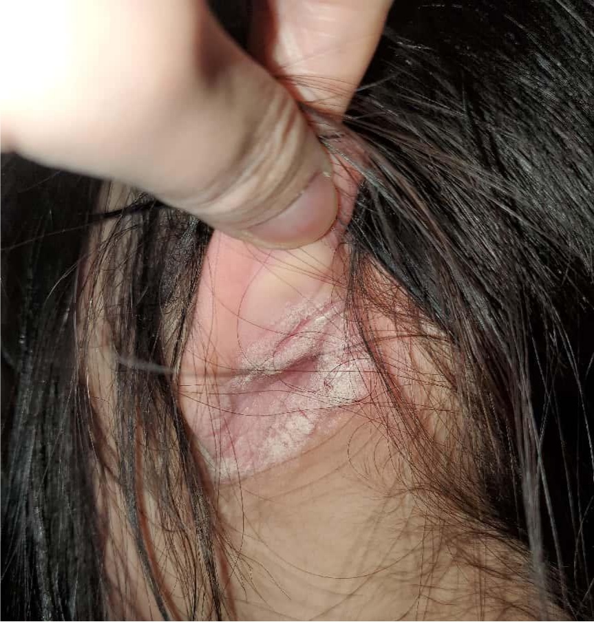 浙江一初三女生患上怪病,一到傍晚就全身痒!竟是源于学习压力 浙江一初三女生患上怪病,一到傍晚就全身痒!竟是源于学习压力