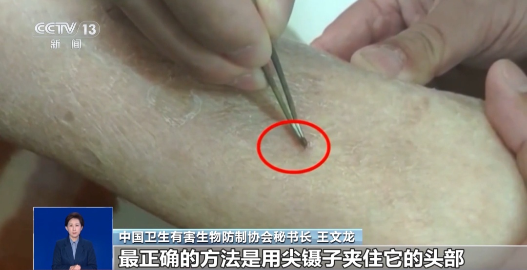 蚊子偏爱O型血?被蜱虫叮咬得用火烧?真相是→ 蚊子偏爱O型血?被蜱虫叮咬得用火烧?真相是→