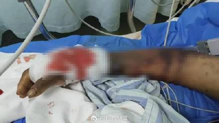 四川八旬老人被毒蛇咬伤后续：“真凶”或是原矛头蝮