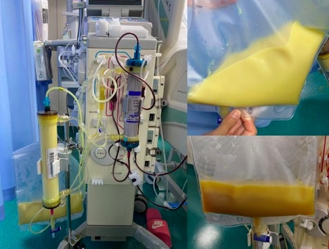 惊险!27岁女子抽出“牛奶血”,1天3杯奶茶惹的祸 惊险!27岁女子抽出“牛奶血”,1天3杯奶茶惹的祸