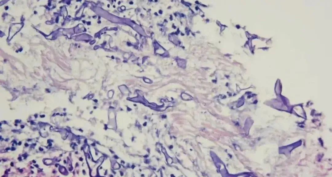 从出现感冒症状到眼球脑子被“啃噬”仅7天!这种致命感染正被大多数人忽视! 从出现感冒症状到眼球脑子被“啃噬”仅7天!这种致命感染正被大多数人忽视!