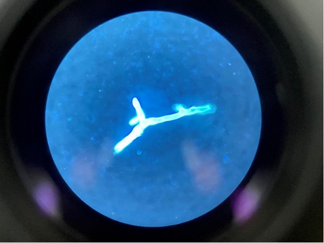 从出现感冒症状到眼球脑子被“啃噬”仅7天!这种致命感染正被大多数人忽视! 从出现感冒症状到眼球脑子被“啃噬”仅7天!这种致命感染正被大多数人忽视!