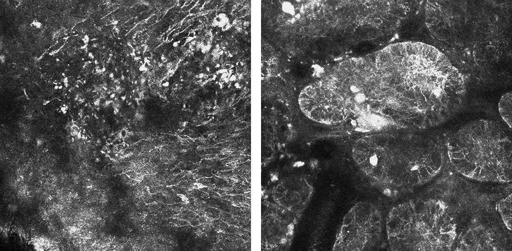 确诊癌症!福州刘女士懵了:还做了激光祛斑…… 确诊癌症!福州刘女士懵了:还做了激光祛斑……