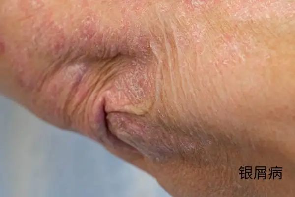 几块钱一管的维 A 酸乳膏,是“护肤圣品”还是致癌毒物? 几块钱一管的维 A 酸乳膏,是“护肤圣品”还是致癌毒物?