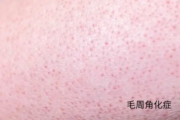 几块钱一管的维 A 酸乳膏,是“护肤圣品”还是致癌毒物? 几块钱一管的维 A 酸乳膏,是“护肤圣品”还是致癌毒物?