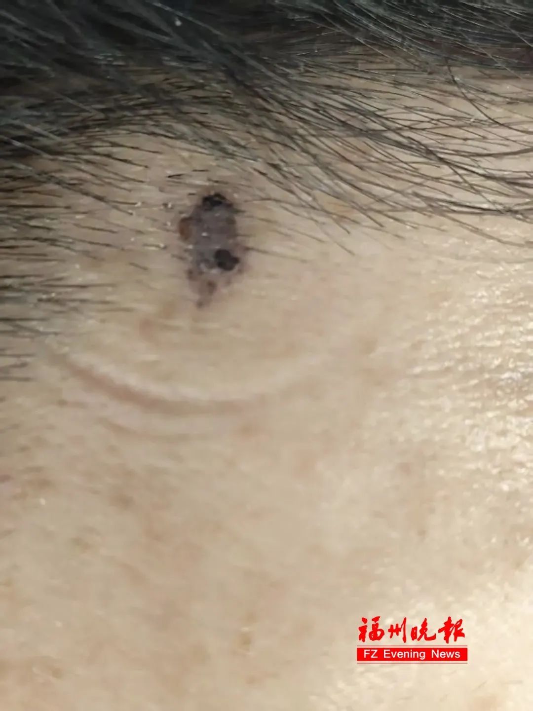 确诊癌症!福州刘女士懵了:还做了激光祛斑…… 确诊癌症!福州刘女士懵了:还做了激光祛斑……