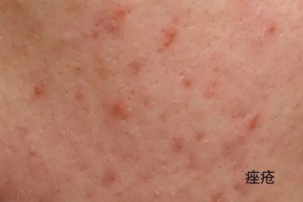 几块钱一管的维 A 酸乳膏,是“护肤圣品”还是致癌毒物? 几块钱一管的维 A 酸乳膏,是“护肤圣品”还是致癌毒物?