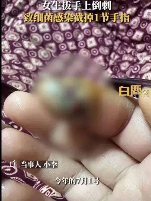 不要拔!不要拔!这习惯的严重后果真会要了命…… 不要拔!不要拔!这习惯的严重后果真会要了命……