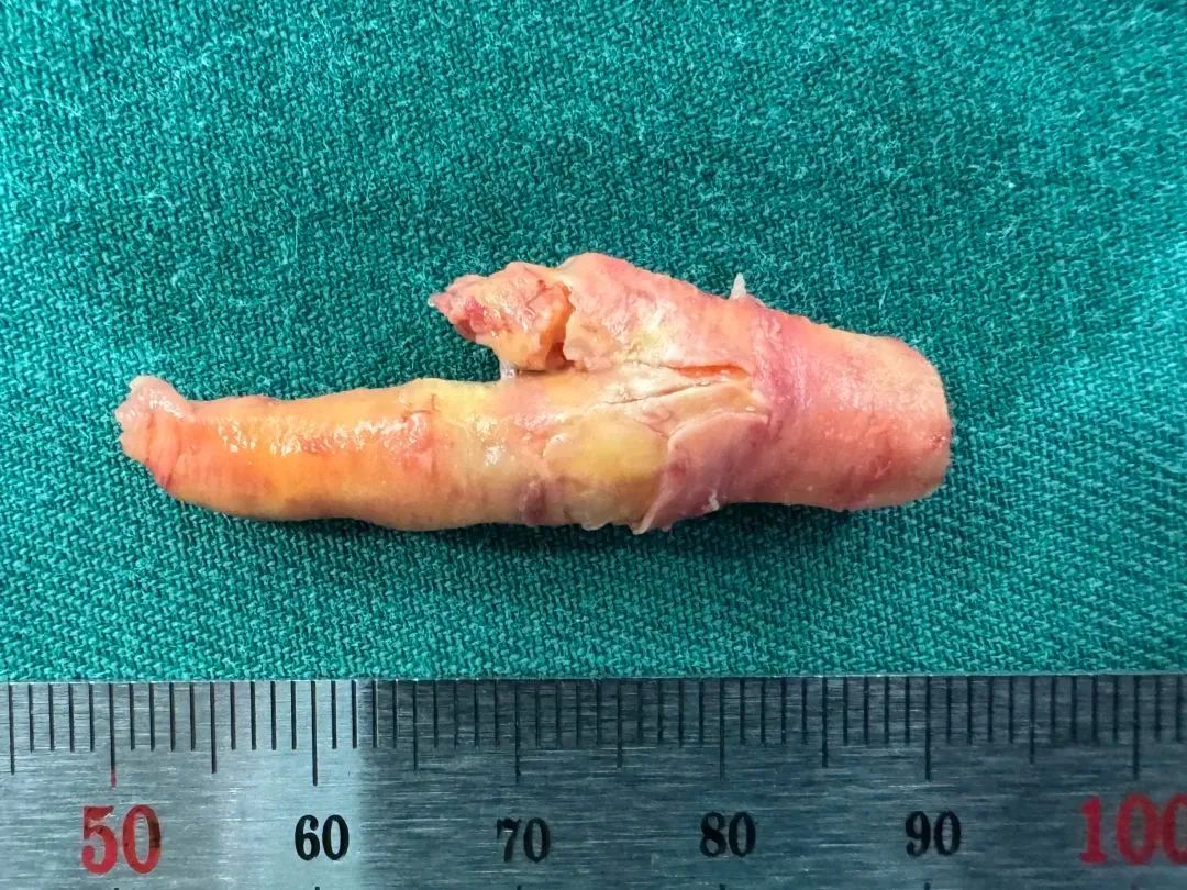 惊呆!男子血管里掏出一只“鸡爪”!这个习惯很多人都有...年龄到了请务必重视 惊呆!男子血管里掏出一只“鸡爪”!这个习惯很多人都有...年龄到了请务必重视