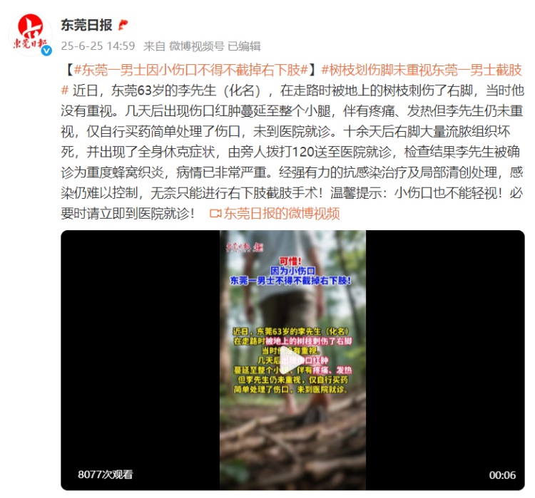 男子被树枝刺伤右脚未重视,十余天后全身休克……确诊为重度蜂窝织炎,右下肢截肢 男子被树枝刺伤右脚未重视,十余天后全身休克……确诊为重度蜂窝织炎,右下肢截肢