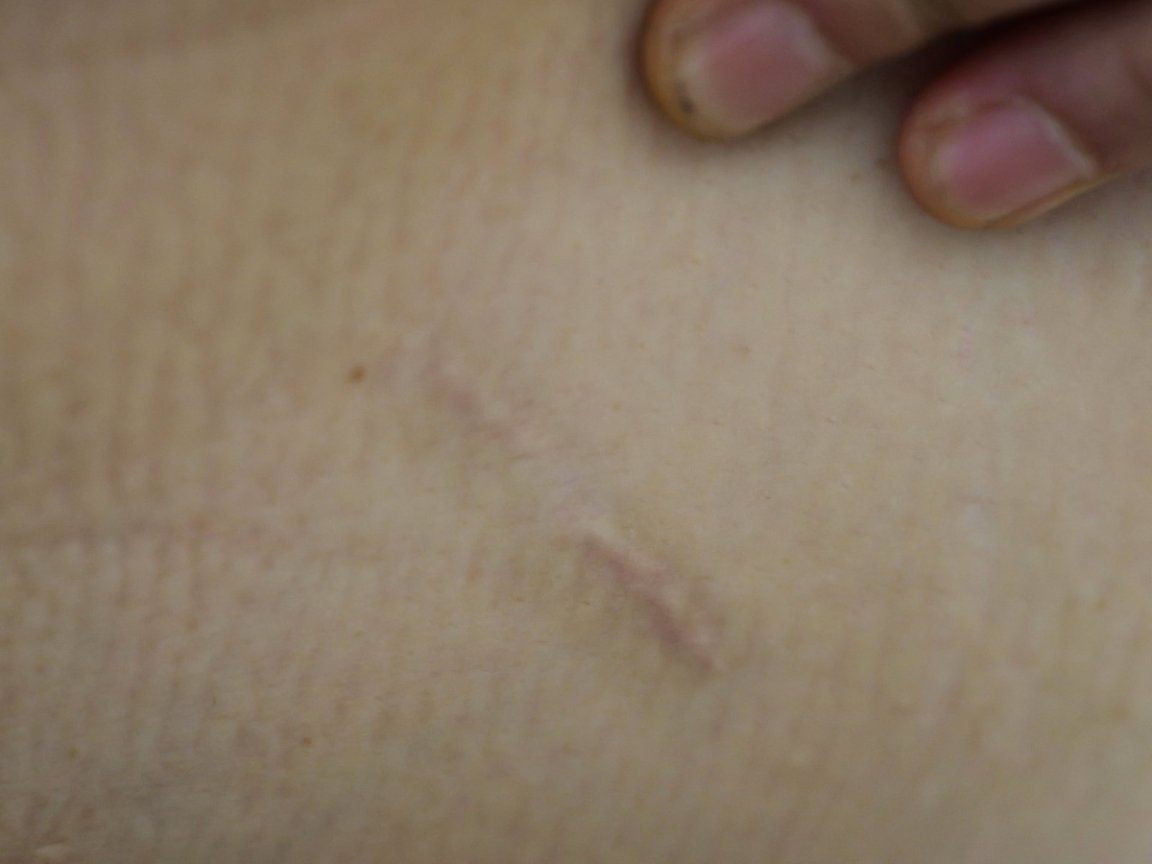 一等功女站长露脸缉毒 10余处伤疤记录生死瞬间 一等功女站长露脸缉毒 10余处伤疤记录生死瞬间