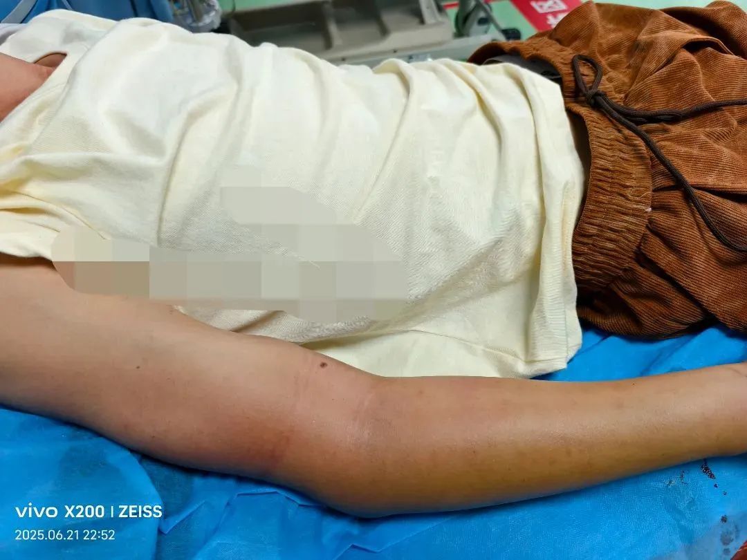 男子遭五步蛇咬伤进ICU！这些“神操作”救了命