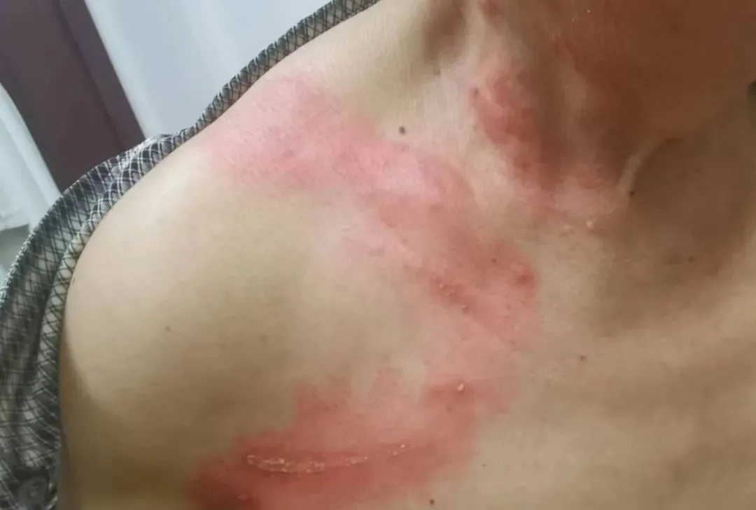 毒液堪比硫酸!女子摸了下脖子就“中招”!千万别碰,有人差点毁容 毒液堪比硫酸!女子摸了下脖子就“中招”!千万别碰,有人差点毁容