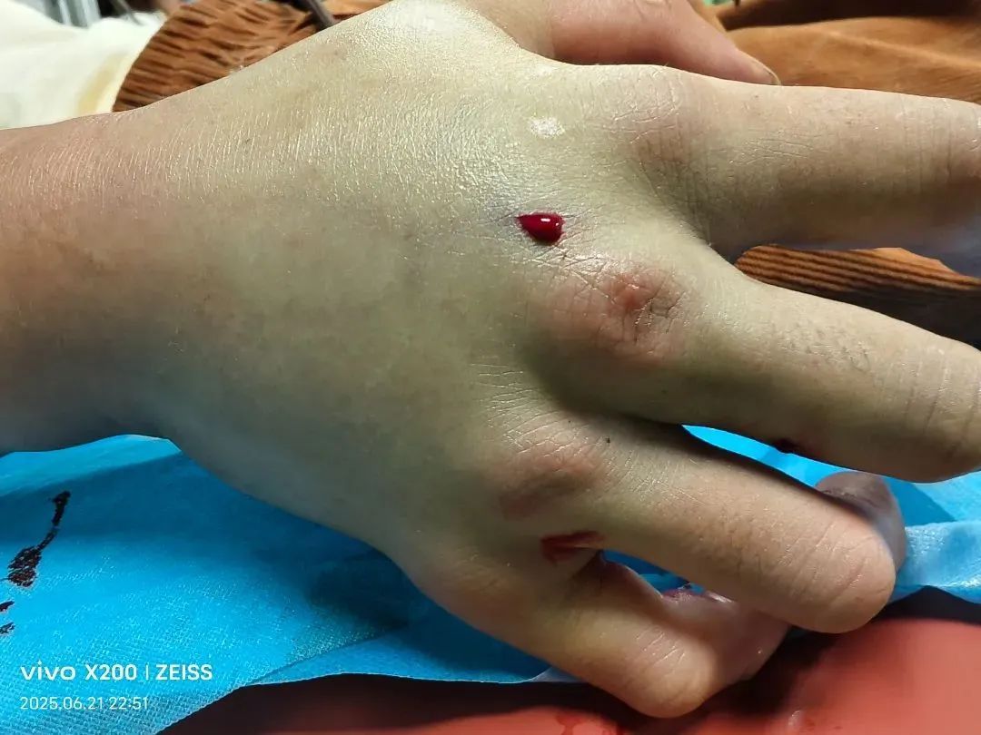 男子遭五步蛇咬伤进ICU！这些“神操作”救了命
