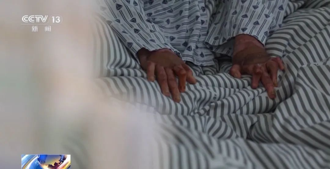 男子吸食火机气体再抽烟引发爆炸，全身深度烧伤