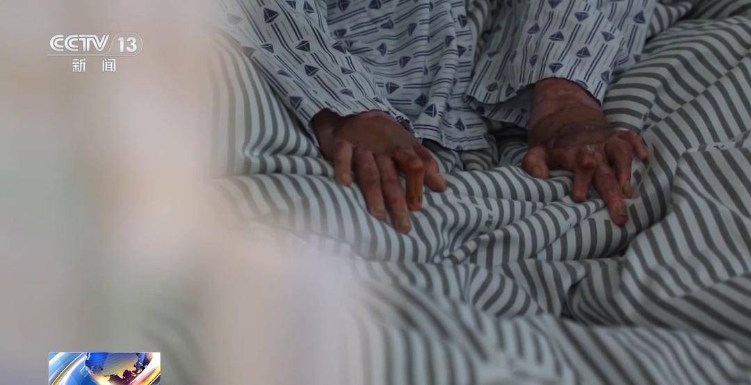 “吸一口毁一生!”18岁少年全身90%烧伤 只因和朋友“上劲”玩这个 “吸一口毁一生!”18岁少年全身90%烧伤 只因和朋友“上劲”玩这个