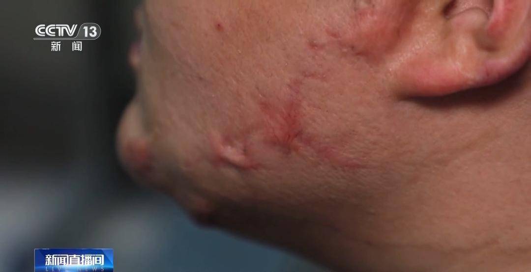 “吸一口毁一生!”18岁少年全身90%烧伤 只因和朋友“上劲”玩这个 “吸一口毁一生!”18岁少年全身90%烧伤 只因和朋友“上劲”玩这个