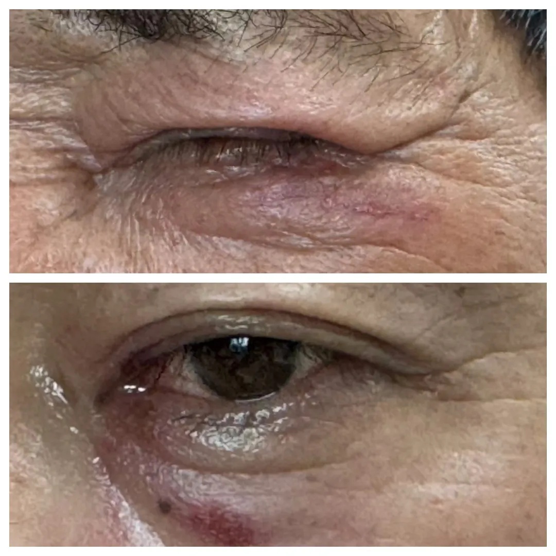 毒液堪比硫酸!女子摸了下脖子就“中招”!千万别碰,有人差点毁容 毒液堪比硫酸!女子摸了下脖子就“中招”!千万别碰,有人差点毁容