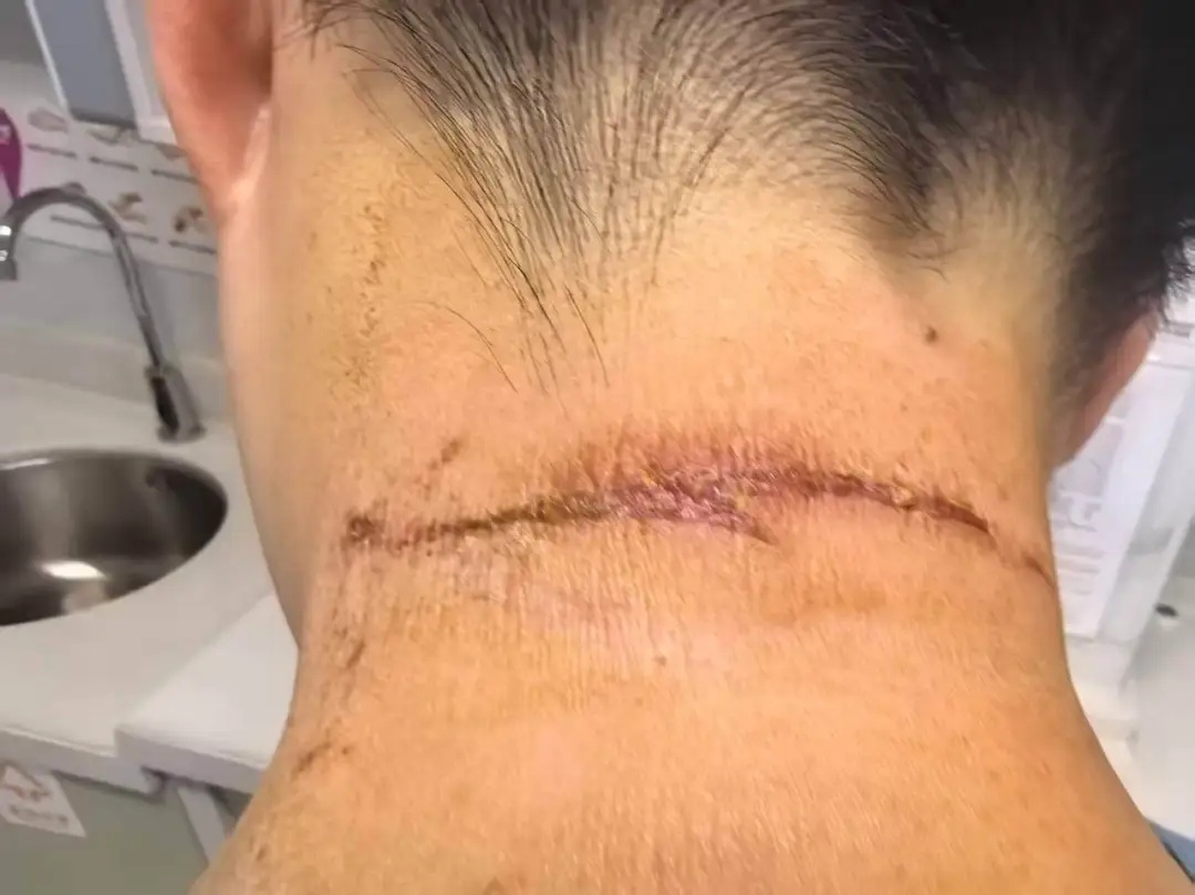 毒液堪比硫酸!女子摸了下脖子就“中招”!千万别碰,有人差点毁容 毒液堪比硫酸!女子摸了下脖子就“中招”!千万别碰,有人差点毁容