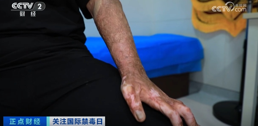 18岁少年全身严重烧伤！只因和朋友“上劲”玩这个→