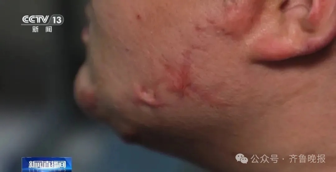 男子吸食火机气体再抽烟引发爆炸,全身深度烧伤,已发生多起,多地紧急提醒→ 男子吸食火机气体再抽烟引发爆炸,全身深度烧伤,已发生多起,多地紧急提醒→